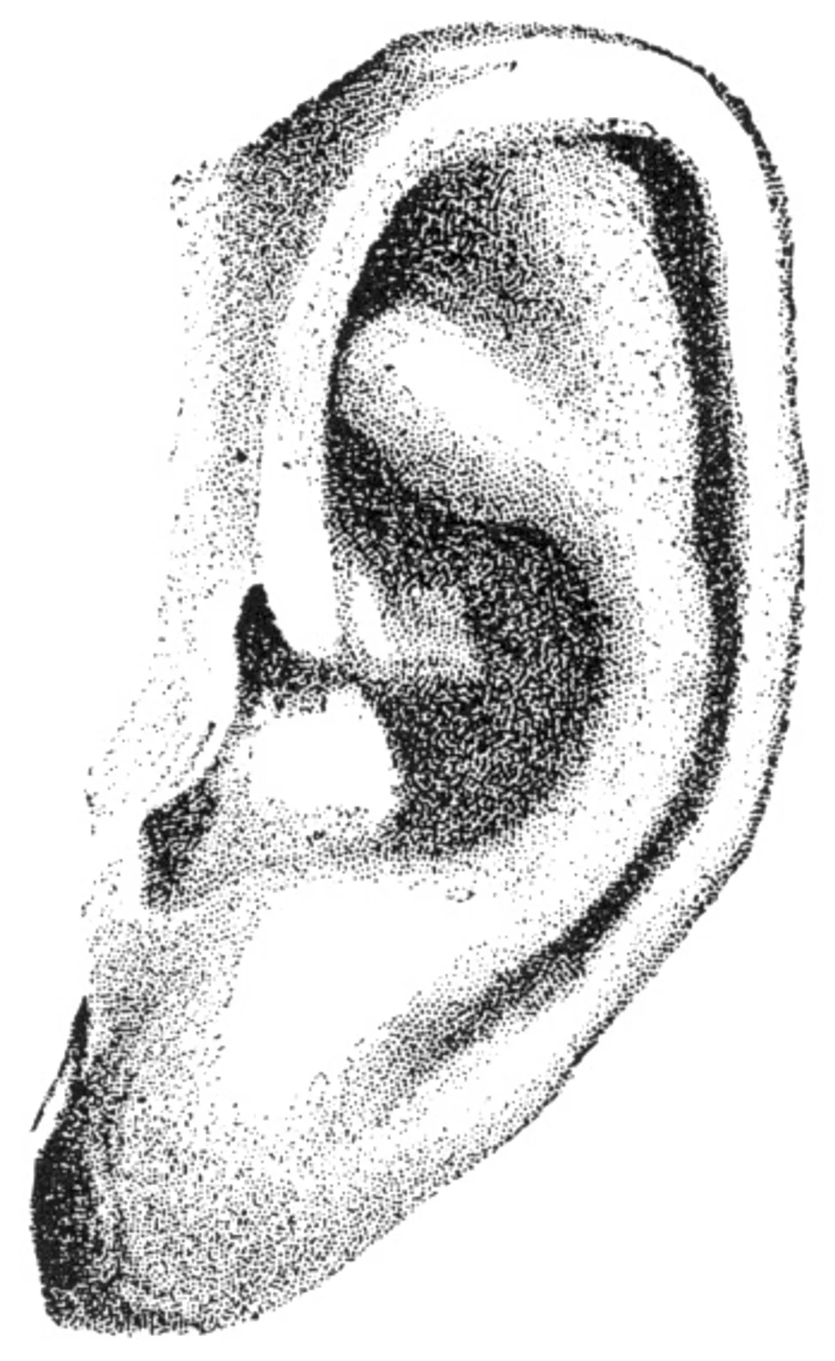 Tinnitus